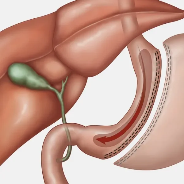 manga-gastrica manga-gastrica